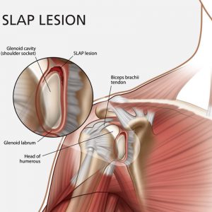 slap-lesion